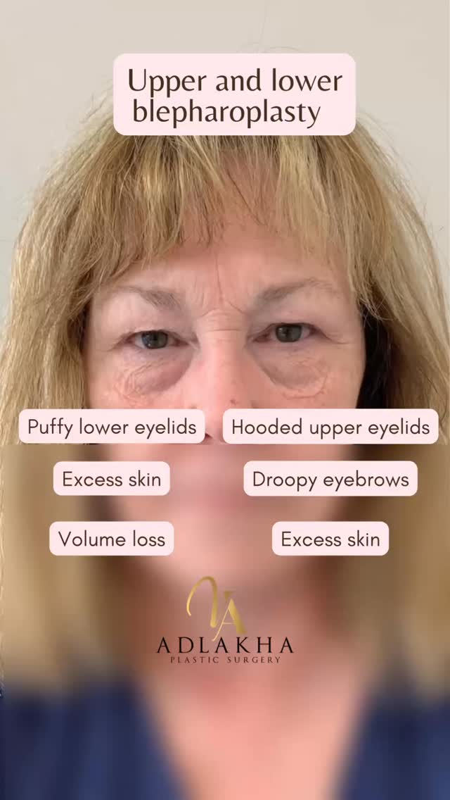 Upper + Lower Blepharoplasty
⬆️ Upper blepharoplasty removes excess skin and restores a natural crease, opening up the eyes and reducing heaviness.
⬇️ Lower blepharoplasty smooths under-eye bags and puffiness, creating a refreshed and rested look.
😍Together, these procedures brighten the eyes, enhance facial harmony, and deliver a youthful but natural result.
To book your complimentary consultation you can:
📞Call 234 458 2010
📲DM @dr.vidhiadlakha
📧Email us info@adlakhaplasticsurgery.com
💻Visit the website in bio
.
.
.
This is an actual patient of Dr. Vidhi Adlakha. All photos are released with consent. Please do not use or distribute without permission.
#adlakhaaesthetics #blepharoplasty #beforeandafter #eyelidsurgery #eyebags #darkcircles #eyes #teartrough #antiaging
#FacialRejuvenation #transformation #hoodedeyes #hoodedeyelids #skincare