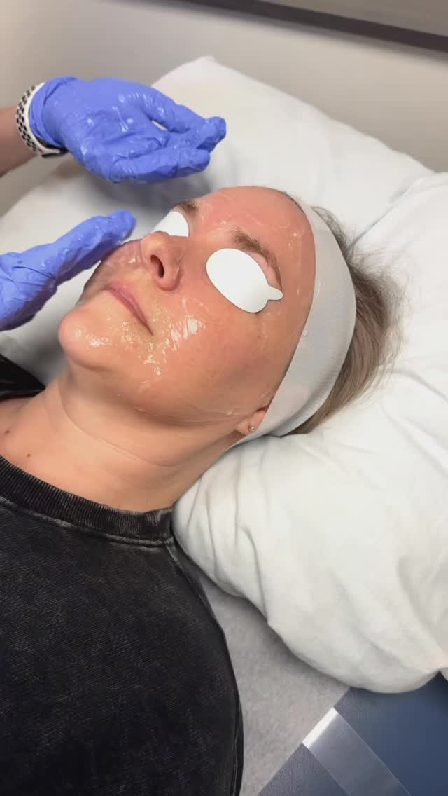 Transform Your Skin with the Stellar M22 IPL & Laser! ✨
Watch as this cutting-edge technology works its magic! The Stellar M22 is your all-in-one solution for a variety of skin concerns, offering safe, effective, and minimally invasive treatments tailored just for you.
💡 What can it do?
* Improve pigmentation and even out skin tone
* Reduce fine lines and wrinkles
* Eliminate vascular lesions
* Remove unwanted hair or tattoos
The best part? You’ll see noticeable results with minimal downtime, so you can get back to your routine in no time.
Whether you’re looking to refresh your complexion or address specific concerns, the Stellar M22 is here to help you achieve radiant, youthful skin.
📅 Book your consultation today and let’s create a treatment plan that’s as unique as you are!
#laser #stellarm22 #lumenis