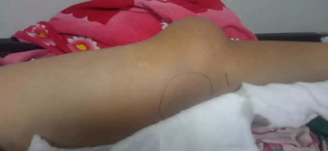 Requerimos de tu ayuda, para niño de 11 años recluidos en el Hospital Central de Valencia, por accidente Ofídico, del día domingo en el Río el Hoyito de San Diego, se solicita apoyo económico para cubrir gastos médicos, está recluido en cuidados intermedios del Hospital Pediátrico
#fundacionvivarium #preservandovidas #snake #envenenamientoofidico