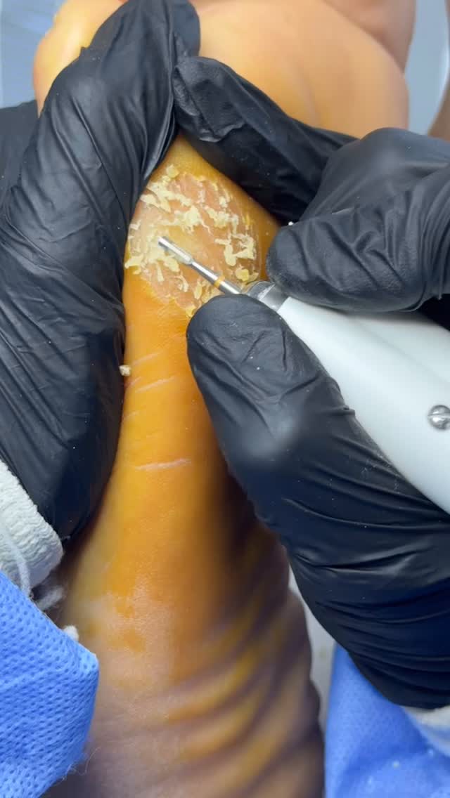 Nasır mekanik temizliği✨