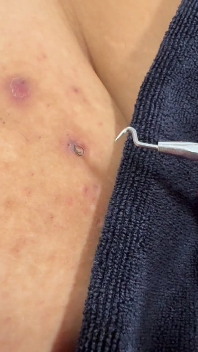 Ingrowns? Not around here! Try a Vajacial and watch them all come out like ✨magic✨
#Extraction #ingrownhairremoval #ingrownhair #vajacials