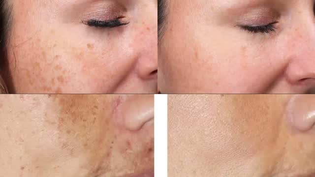 Bye-bye blemishes! Hello confidence!👋 IPL treatments target sun damage, redness and uneven skin tones so your skin can shine bright✨
