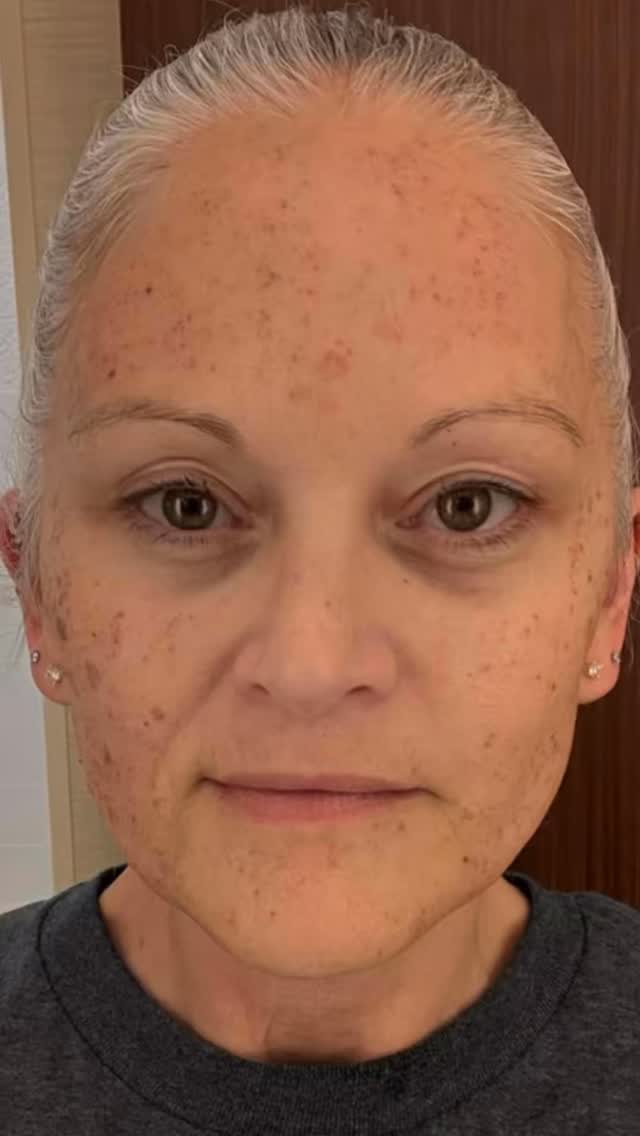 Clear, even, radiant skin... we obviously understood the assignment!
Our Stellar M22 IPL doesn't play! One session. Big results! 🔥
It's laser season, baby! Book your session today!
#frankenmuthaesthetics #frankenmuthmichigan #lumenism22 #stellarm22 #lasertreatment #lumenis #ipl