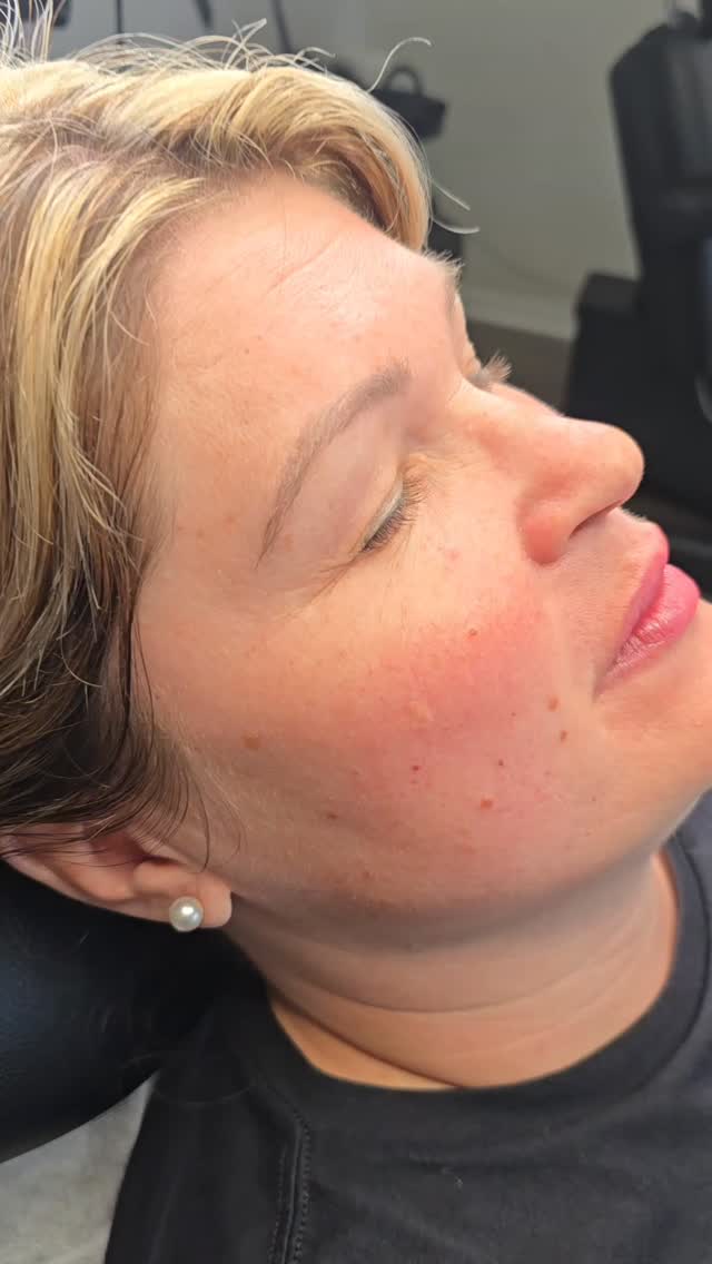 Helping restore brows, one pair at a time 🤌🏽
I used the nano technique combined with shading to build these sparse brows and give them an overall structured shape.
I can work over previous permanent makeup on a case by case basis. Previous microblading done by another artist.
www.charlestonpermanentmakeup.com
#permanentmakeup #combobrows #powderbrows #nanostrokes #browslipseyes #cosmetictattoo #microbladingcharleston #SouthCarolina #Charleston #Mtpleasant #Summervillesc #Ladson #JamesIsland #JohnsIsland #Kiawah #Myrtlebeach