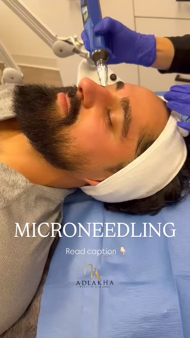 Menās aesthetic treatments are on the rise š
Men now account for ~15ā20% of aesthetic treatments, with skin treatments leading the way.
What is microneedling? š
A minimally invasive skin treatment that improves skin quality without changing facial features.
How it works š¬
⢠Creates controlled micro-injuries
⢠Stimulates natural collagen & elastin
⢠Triggers skin repair over time
Why we love it āØ
⢠Better texture & tone
⢠Minimizes pores
⢠Helps acne scars & fine lines
⢠Minimal downtime
⢠Natural, masculine results
To schedule an appointment:
šCall 234 458 2010
š²DM @dr.vidhiadlakha or @skinspecialistyolanda
š§Email us info@adlakhaplasticsurgery.com
š»Visit the website in bio
.
.
.
This is an actual patient of Dr. Vidhi Adlakha. All photos are released with consent. Please do not use or distribute without permission.
#adlakhaaesthetics #microneedling #skinpen morpheus8 collagen diamondglow hydrafacial medicalfacial medspa collangenbanking skincare antiaging diamondglowfacial femalesurgeon antiwrinkle aesthetics aesthetician sculptra skincareroutine SkinHealth CollagenBoost glassskin prp prf skincareroutine maleaesthetics
