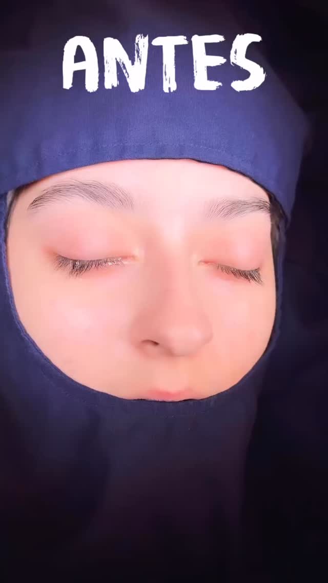 🔹La clave para una rinoplastia armónica reside en la personalización. Analizamos cada detalle de tu rostro para asegurar que el resultado sea auténtico, sutil y, sobre todo, tuyo. ¡Agenda tu consulta!.
🔹Resultado inmediato Rinoplastia Estética y Funcional.
🔹 Gracias a mi excelente paciente por su confianza y permitir compartir su resultado.
🔹”Made by hand. Crafted with passion”
🧑⚕️ Dr. Guillermo Guerra Gil de Leyva
🏥 Hospital Ángeles Valle Oriente
📱 81-1252-0132
🎓Universidad de Monterrey
👃 Rinoplastia Estética y Funcional
🚫 No taponamiento
Cédula Profesional: 3070499
Cédula Especialista: 4503273
No. Certificación CONACEM: GUG-1748/04
Aviso de Publicidad COFEPRIS: 2419032002A00111
❕Paciente autoriza difusión de imágenes con fines académicos e informativos.
❕Los resultados finales se pudieran observar hasta un año de la cirugía y dependerá tanto del compromiso del cirujano como del paciente, así como del tipo de cirugía, tipo de piel, cuidados post-operatorios, etc.
#CirugíaFacial #RinoplastiaEspecializada
#rinoplastia #rhinoplasty #septoplastia #septoplasty #rinoseptumplastia #rhinoseptoplasty #nosejob #nose #nosesurgery #tabiquenasal #otorrinolaringologia #entsurgery #cirugianasal #cirugiatabique #cirugiaesteticanasal
#belleza #confianza #autoestima
#cosmeticsurgery
#otorrinolaringologiamonterrey #otorrinomonterrey #beforeandafter #antesydespues
#estructuredrhinoplasty
#rinoplastiaestructurada
#rinoplastiaultrasonica
