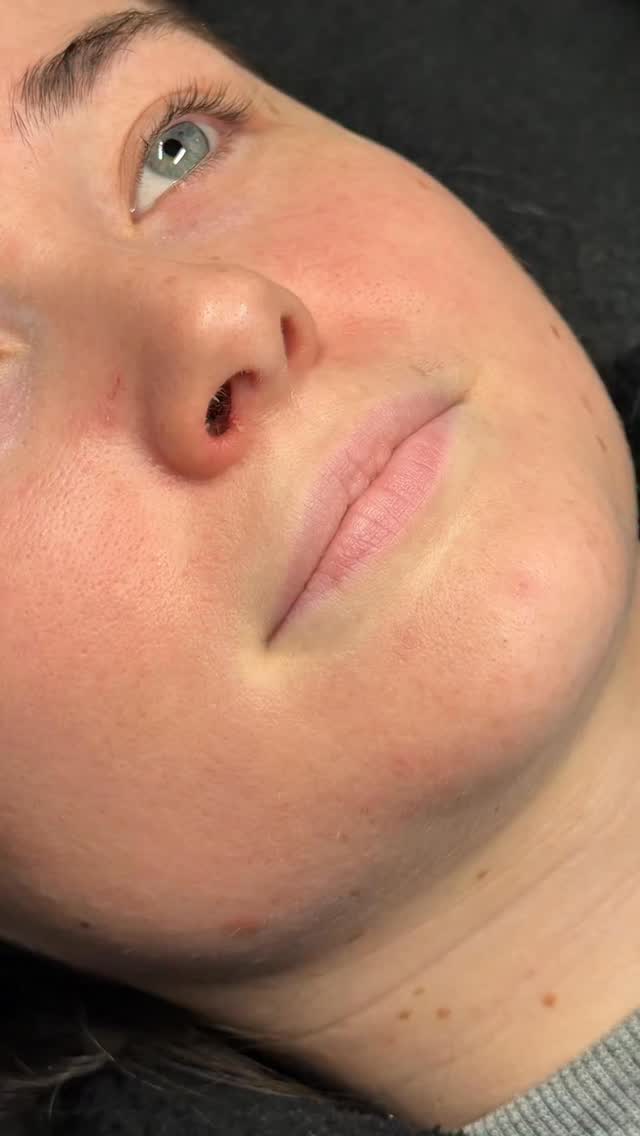 New Year New Lips 2️⃣0️⃣2️⃣6️⃣ 🎉🫦
1.1ML Russian Lips
A stunning refresh for my gorgeous client who wanted to feel like herself again 💋⌛️
We focused on adding soft volume keeping them in proportion to suit her face perfectly. Using the Russian Lip technique for a controlled lift, improved structure and definition with a defined Cupid’s bow without overfilling - just as she asked 🥰
Every treatment is tailored to you, respecting facial anatomy, balance and harmony to achieve lips that enhance your features 💁♀️
Link in Bio or DM to Book ❤️
#russianlipswestsussex #russianlips #lipgoals #naturalenhancements #aestheticsburgesshill