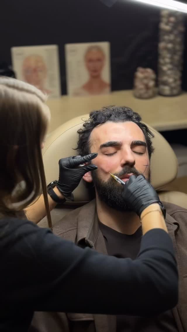 I always loved plumpy cheeks, it’s definitely restoring a youthful appearance, especially in this case for Mitch, using only one syringe of dermal filler.
What do you think?
#dermalfillers #cheekfiller