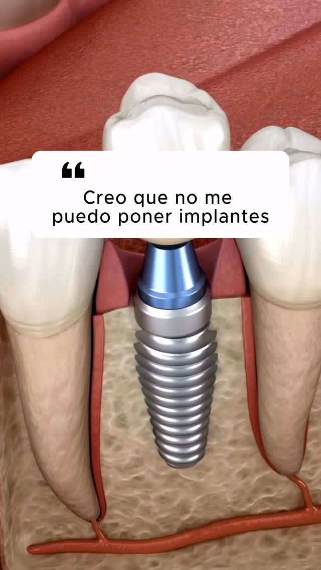 🤔 “Creo que yo no puedo ponerme implantes…”
Es una frase que escuchamos a diario.
La realidad es que muchas personas que lo creen, SÍ pueden.
Edad, miedo, falta de hueso, enfermedades controladas… 🙄
👉 No todo es un “no”, a veces solo es un “aún no”.
Con un buen estudio previo, radiografías y planificación personalizada, encontramos la mejor solución para ti.
💬 ¿Alguna vez te han dicho que no podías ponerte implantes? Cuéntanos 👇
#ImplantesDentales #MitosDentales #ClínicaTresserra #CirugíaOral #DentistaBarcelona