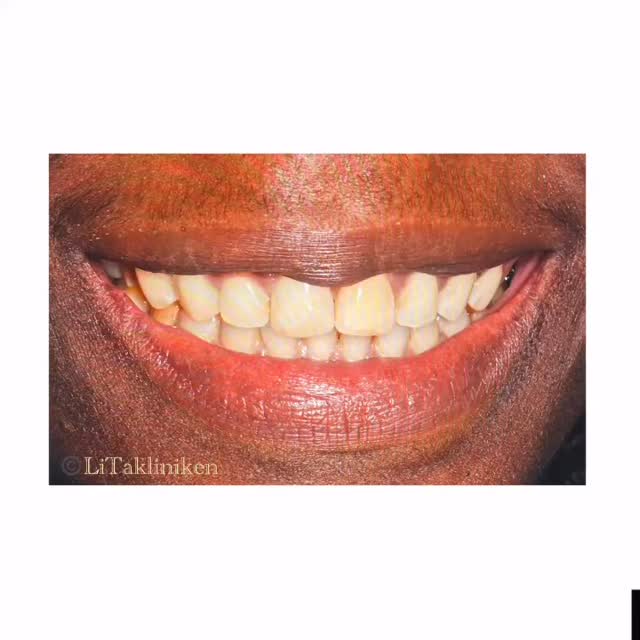 💎 Ortodonti gör skillnad 💎
Behandling av uttalad glesställning i över- och underkäken samt proklinerade incisiver med aligners (@invisalign) och finishering med fast apparatur i ÖK-fronten för bästa resultat 😀
Vi tackar vår fina patient för ett gott samarbete 🙏
#orthodontics #aligners #braces #orthomagic
#litakliniken