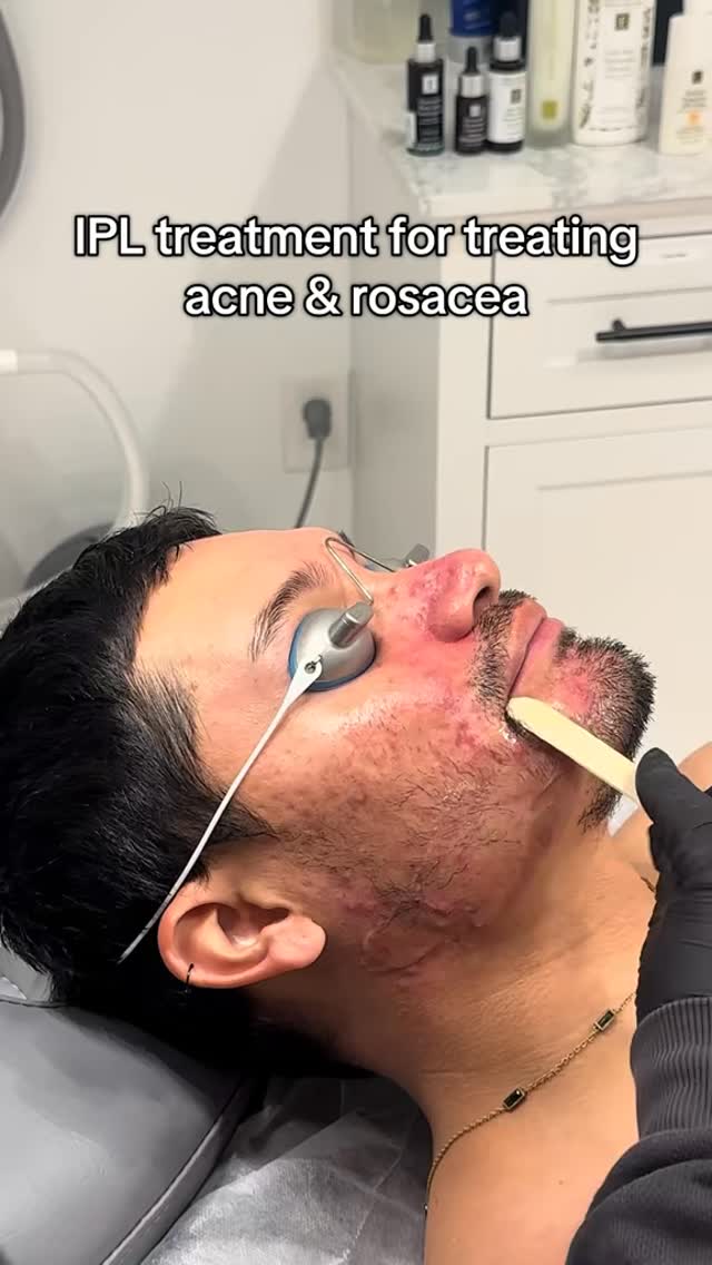 IPL treatment ⚡️
Benefits: kills acne causing bacteria
Reduces inflammation
Helps control oil production
Fades discoloration
Improves texture & scaring
#lasvegas #medspa #ipl #ipltreatment
#laser