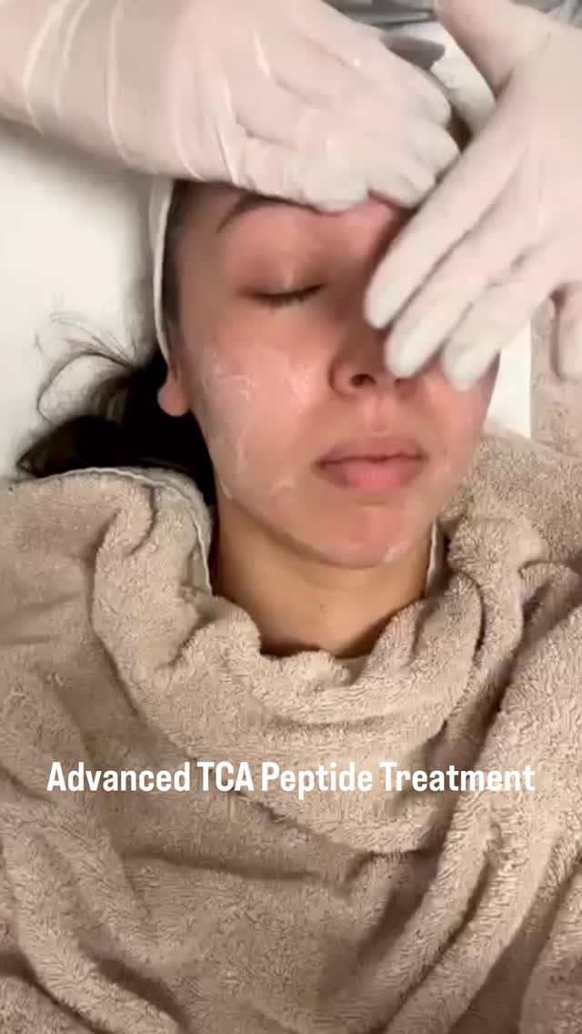 TCA Peptide Treatment
Een intensieve huidverbeterende behandeling die werkt op meerdere huidniveaus.
Een TCA 12% peel vernieuwt de huidoppervlakte en stimuleert celvernieuwing en collageenaanmaak.
Daarna worden klinische peptides van Préime via microneedling dermaal ingesluisd. Deze peptides werken als signaalstoffen in de huid en ondersteunen collageen en elasticiteit van binnenuit.
Door deze combinatie wordt zowel de bovenste huidlaag als de diepere huidstructuur aangepakt.
Een collageenvliesmasker met hyaluronzuur en rood LED-licht ondersteunen het herstel en versterken het resultaat.
Het resultaat: een egalere huid, meer stevigheid en een gezonde, natuurlijke glow zichtbaar na het herstelproces.
Ideaal voor collageenstimulatie, huidvernieuwing en het verbeteren van de algehele huidkwaliteit.
#huidtherapie#skincare#microneedling#antiaging