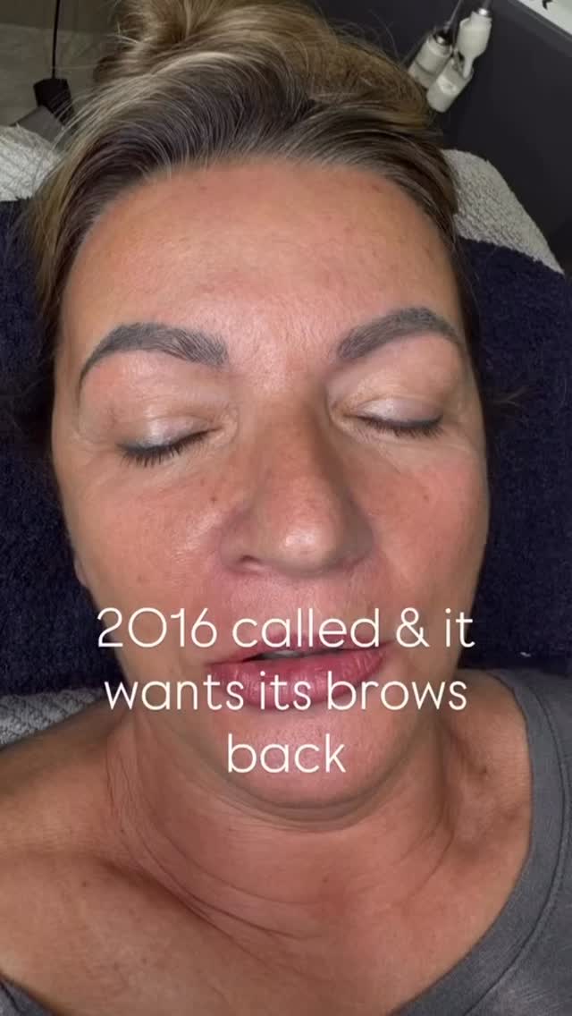 2016 called… and they want their brows back 📞😅
But we’re not going backwards — we’re upgrading ✨
Let’s start again, 2026 style 💁♀️
Fresh canvas. Fresh brows. Fresh era.
Laser tattoo removal on old brow work = your glow-up begins now 💫
Book now 🔥0411699227