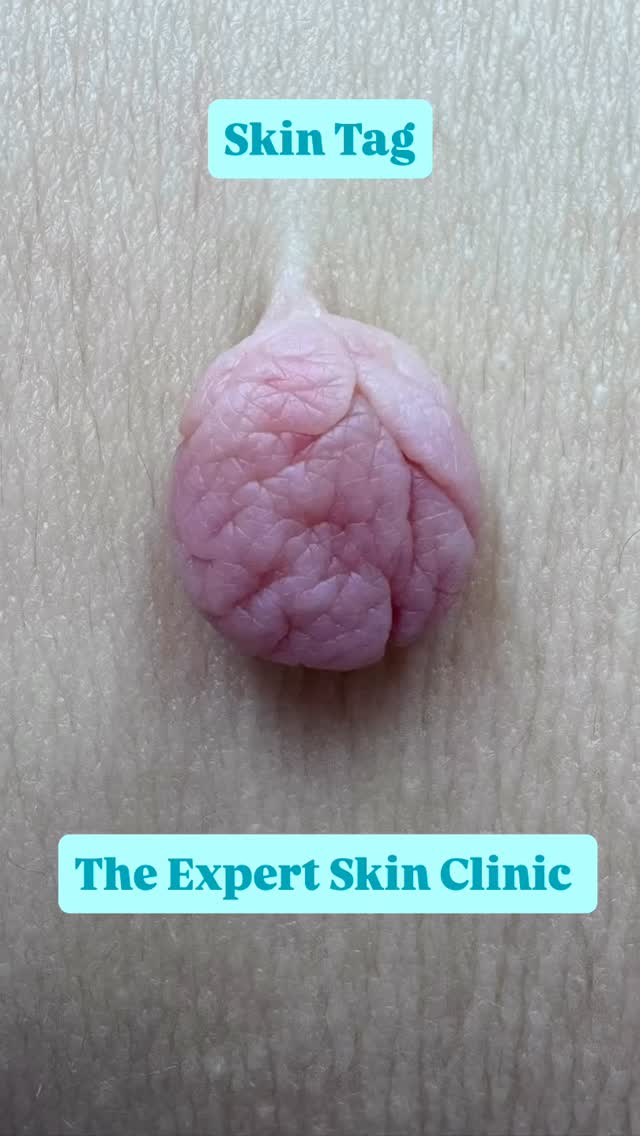 Large skin tag removal. Removed safely, precisely, and with results you can see straight away.
This is a before and immediately after from one treatment, using advanced techniques to remove the lesion while supporting healthy healing.
If you have something similar that’s catching, growing, or just bothering you, you can start the process with a professional assessment.
Book your blemish consultation online�You’ll find the link in my bio
#skintagremoval #blemishremoval #skinclinicuk #beforeandafter #skinconfidence