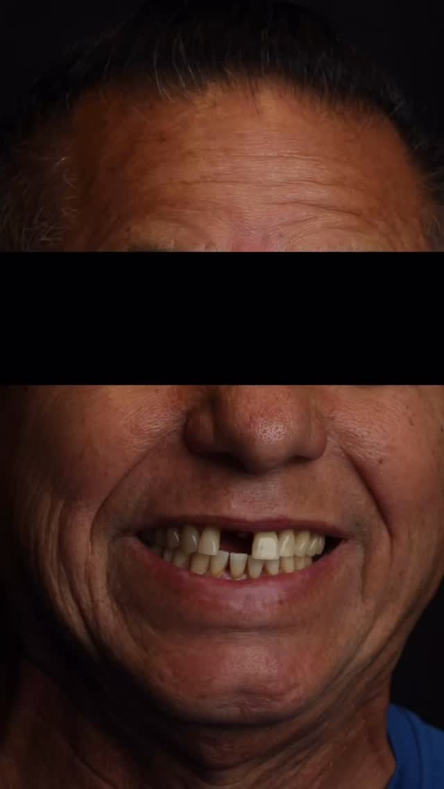 His story: He’s been wearing a removable partial to replace his one missing tooth. It was tough to wear, difficult to eat with, and moved around a lot. He was able to get an implant with us and finally said bye bye to his partial! #orlandodentist #dentalimplant #confidencerestored