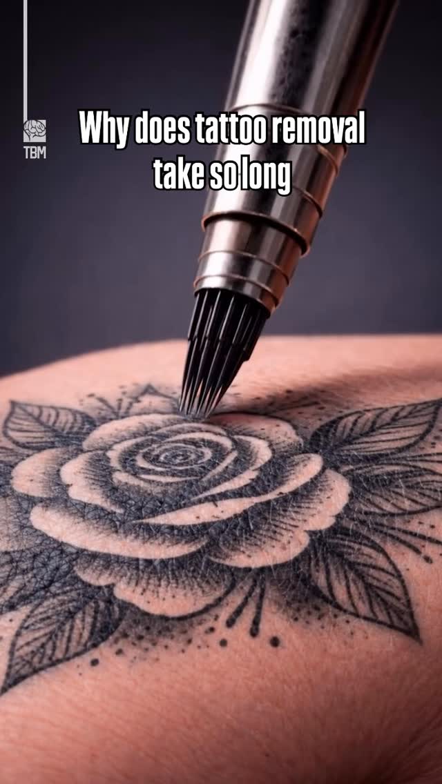 “Why does tattoo removal take so long?” 👀
Because it’s not just the laser… it’s your biology.
✨ Here’s the science:
🧬 Ink sits in the DERMIS
Not the surface — so your body can’t just shed it.
⚡ Laser breaks it down
We don’t “remove” the ink instantly — we shatter it into tiny particles.
💧 Your lymphatic system clears it
Your body slowly flushes the ink over weeks between sessions.
⏳ Why multiple sessions?
• Ink depth + density
• Color 🎨
• Skin type
• Your immune system
✨ This is a process — not a quick fix.
⸻
💎 Why we use PicoSure Pro:
⚡ Ultra-fast picosecond technology = better ink shattering
🎯 Targets stubborn pigment (even difficult colors)
🔥 Less heat = safer for the skin barrier
✨ Faster clearance + better results
⸻
Healthy skin > rushing results. Always.
Save this before starting your tattoo removal journey 🤍
#PicoSurePro #TattooRemoval #SkinEducation #LaserTattooRemoval #fyp