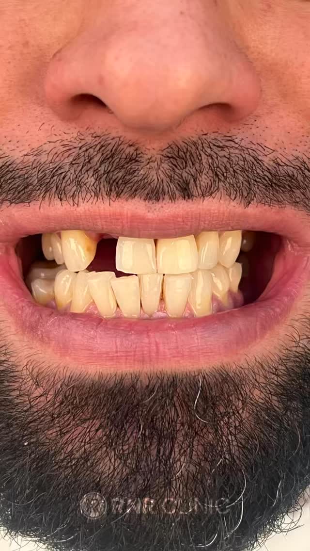 ✨ Modernes Design, sterile Umgebung und ein erfahrenes Ärzteteam für Ihr perfektes Lächeln.
🦷 In unserer komfortabel gestalteten Klinik planen wir Ihre Behandlung sicher und professionell mit unseren spezialisierten Zahnärzten.
🇩🇪 Besonders für unsere Patienten aus Deutschland bieten wir eine VIP-Betreuung und eine rundum organisierte Behandlung in Istanbul.
📩 Für ein kostenloses Beratungsgespräch und ein individuelles Angebot schreiben Sie uns gerne per DM.
#dentaltourism #zirkonkrone #implantat #zahnklinik #hollywoodsmile