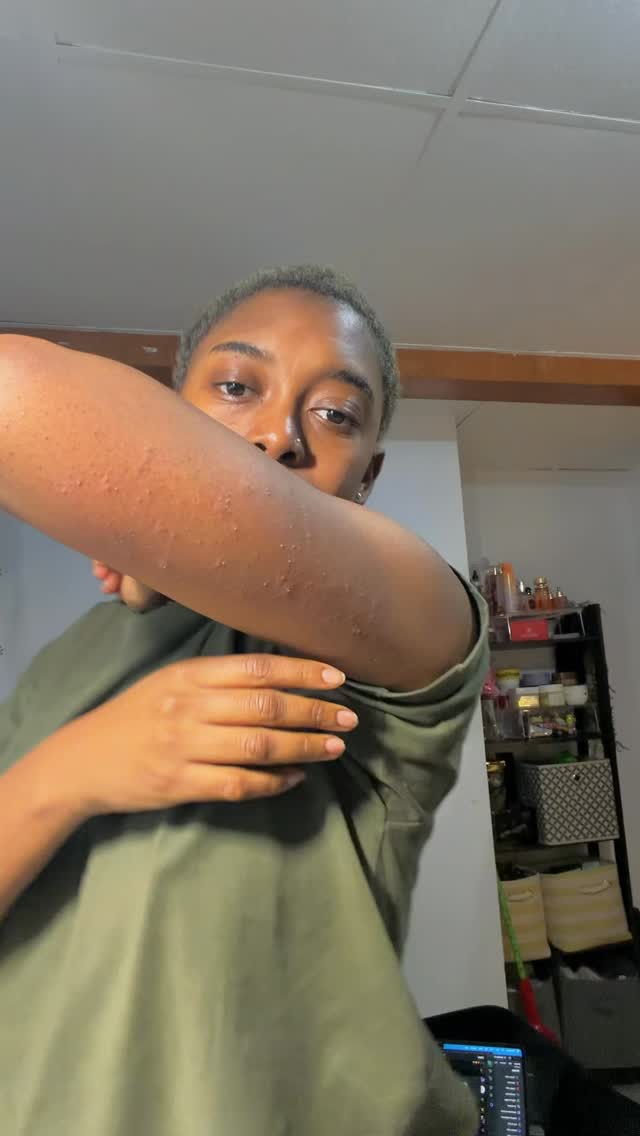 Smooth skin is a goal I stopped trying to achieve because I am more concerned with my skin being healthy than it looking aesthetically pleasing.
And while you might think both are the same I can promise you that ignoring skin health for aesthetics has led many down the road of damage me included.
I cannot tell you what over exfoliation has done to my skin over the years 😭😭 because I was chasing after smooth skin
Which is interesting because the healthier your skin gets the better it looks eventually
That being said if you have textured skin and are looking for a healthy and balanced bodycare routine to help restore your skin barrier here’s mine
- @olay Retinol Body Wash - use at night to boost skin cell turnover to shed dead skin cells faster
@laboratoiresvrca Topiasyle Clemsing Oil - a.m body wash to smooth and hydrate while cleansing
@goodmolecules B5 hydrating body serum -
with panthenol, beta-glucan , polyglutamic acid for moisture and skin barrier repair
@oseamalibu Undaria Algae Body Butter - lasting hydration and skin repair with ceramides , Shea butter and Undaria seaweed
#dryskincare #strawberryskin #atopicskin #smoothskin