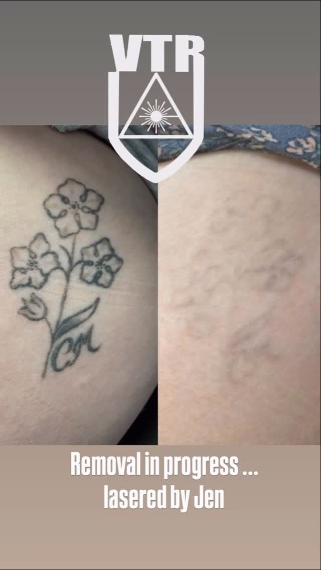 Full Removal is a process! Thank-You to all of my clients who continue to trust me and the removal process! #victoriatattooremoval #tattooremoval #lasertattooremoval #urgetattoos #tattooregret