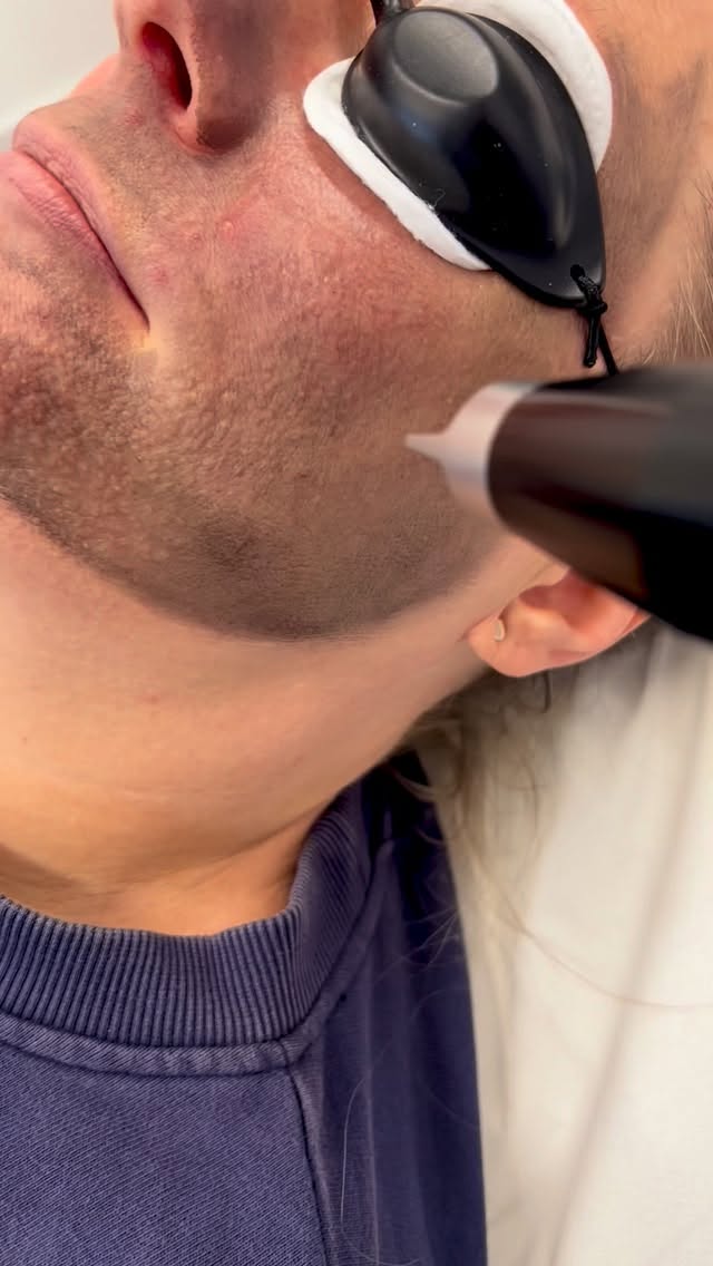 Carbon laser peels offer benefits such as a deep pore cleanse, reduction of acne and oiliness, treatment of mild acne scars and hyperpigmentation, improved skin texture and tone, diminished fine lines and wrinkles, and overall skin rejuvenation due to collagen stimulation.
Often nicknamed the “Hollywood Peel,” the treatment involves applying a liquid carbon solution to the skin, which absorbs impurities and dead skin cells, followed by laser energy that vaporizes the carbon and contaminants, leaving skin feeling refreshed and smooth with minimal downtime.
Key Benefits
Deep Cleansing & Pore Refinement:
The activated carbon absorbs oil, debris, and impurities from deep within the pores. The laser then vaporizes these, resulting in a deep cleanse and smaller-looking pores.
Acne & Oil Control:
The treatment effectively targets the causes of acne by removing oil and bacteria from pores, which can reduce existing breakouts and prevent new ones.
Skin Rejuvenation:
By stimulating collagen production, the peel can lead to firmer, younger-looking skin.
Improved Texture & Tone:
It removes dead skin cells and addresses pigmentation irregularities, leading to smoother skin and a more even complexion.
Reduction of Fine Lines & Wrinkles:
The stimulation of collagen and removal of surface layers helps to soften the appearance of superficial fine lines.
Reduced Hyperpigmentation:
Carbon laser peels can help to reduce the appearance of dark spots and other pigment irregularities.
Minimal Downtime:
The procedure is non-invasive and often results in a healthy glow, with redness typically subsiding within an hour, earning it the “Hollywood Peel” nickname.
#romsey #totton #warminster #westbury #michelmersh