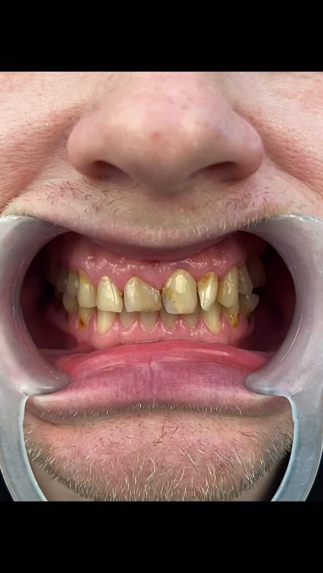 Vom ersten Moment bis zum perfekten Lächeln ✨
Unsere Patienten vor Beginn ihrer Zahnbehandlung – und das beeindruckende Ergebnis nach erfolgreichem Abschluss 🦷
Ein neues Lächeln bedeutet nicht nur schöne Zähne, sondern auch mehr Selbstbewusstsein und Lebensqualität.
Vertraue auf Qualität, Erfahrung und Präzision.
#dental #fyp #deutschland #smile #teeth