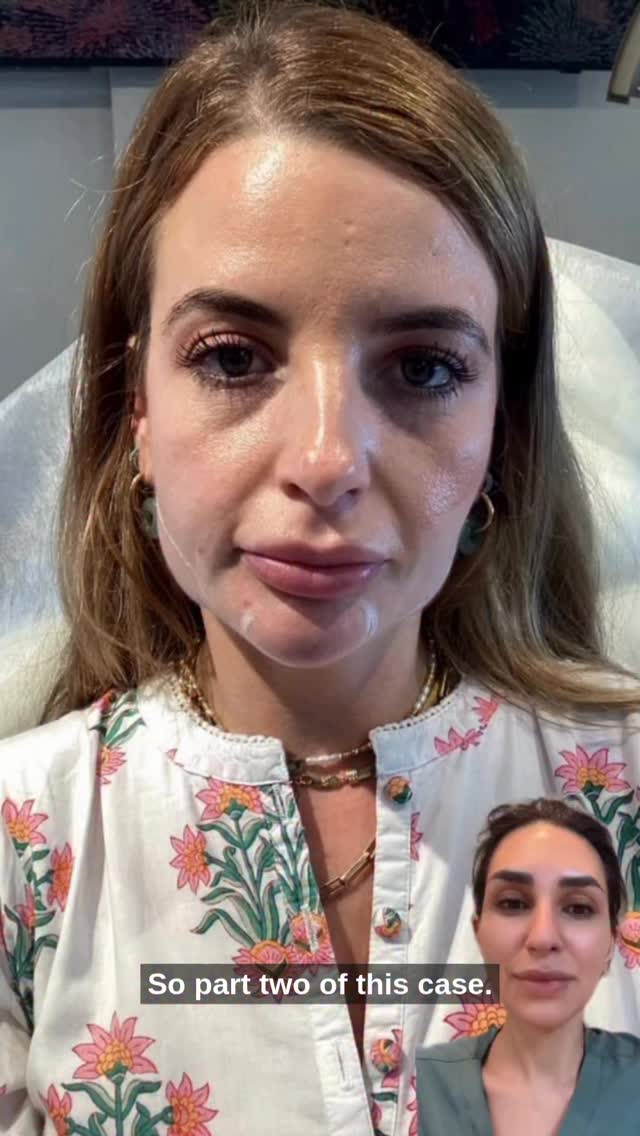 🟣Dissolving & Correcting - Part Two🟣
After dissolving and refining the lips and lower face, we’ve now focused on the midface and tear trough to restore volume.
This marks the final phase of her plan so far. The result is a refreshed, lifted, and beautifully balanced appearance.