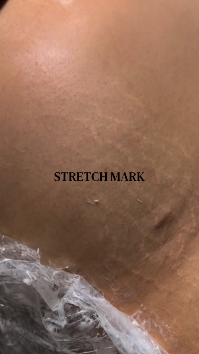 Loose skin? Fine lines? Texture that’s just… there? We have a new secret weapon at Oh La La Brow Bar, and it doesn’t involve a scalpel or a needle. ✨
Meet Fibroblast (aka Plasma Pen) — your new go-to non-surgical option for real, lasting skin rejuvenation. It’s a fantastic alternative to things like Botox if you’re looking for something that works with your body’s natural processes to improve skin quality, not just the visual effect.
So, how does it work? Fibroblast creates tiny micro-injuries on the surface of the skin to stimulate collagen production and tightening. This means your skin literally repairs itself, becoming firmer and smoother over time. No filler. No surgery. Just your skin doing what it does best, but better.
We use it for:
✨ Skin tightening (face + body)
✨ Stretch mark reduction
✨ Scar revision
✨ Fine lines + crepey skin
✨ Skin tags
And the best part? We are so excited to introduce the newest member of the Oh La La family who will be providing this amazing service: meet Krissol! 🤎 Krissol specializes in body treatments, skin tightening, PMU, and SMP. She is incredibly talented, and we know you are going to love her warm energy and expertise just as much as we do.
⚠️ A quick note on the process: This is NOT a “walk in and do it” service. You need a consultation first so Krissol can make sure you’re a good candidate and go over the healing process. Because yes — there is downtime. You’ll have tiny dots and a few days of healing, and then the magic starts. Results build over weeks as your skin regenerates.
If you’ve been looking in the mirror thinking, “something needs to tighten up a little…” this is exactly what you’ve been waiting for.
📍 Consultation required before booking.
📲 Book your consultation through the link in our bio or DM us “PLASMA” to get started!
#Fibroblast #PlasmaPen #SkinTightening #StretchMarkRemoval #ScarRevision