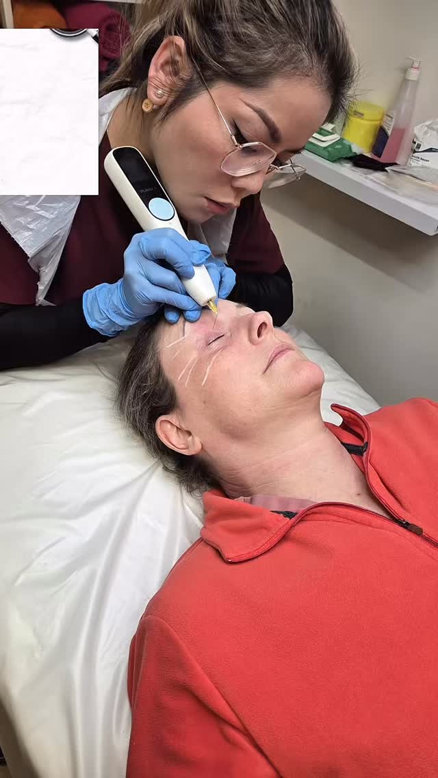 FibroBlast Plasma Pen 🔥✨50% OFF THIS COURSE 🩼🩼🩼🩼🩼🩼🩼🩼
Lift, tighten & rejuvenate your skin with this non-surgical treatment targeting fine lines, scars, pigmentation & signs of ageing. Quick, virtually pain-free with minimal downtime – the ultimate skin reset for smoother, firmer, glowing results.
#Fibroblast #PlasmaPen #SkinTightening #AntiAgeing #SkinRejuvenation Aesthetics GlowUp FineLines ScarRevision Pigmentation NonSurgical BeautyClinic SkinGoals YouthfulSkin AdvancedAesthetics