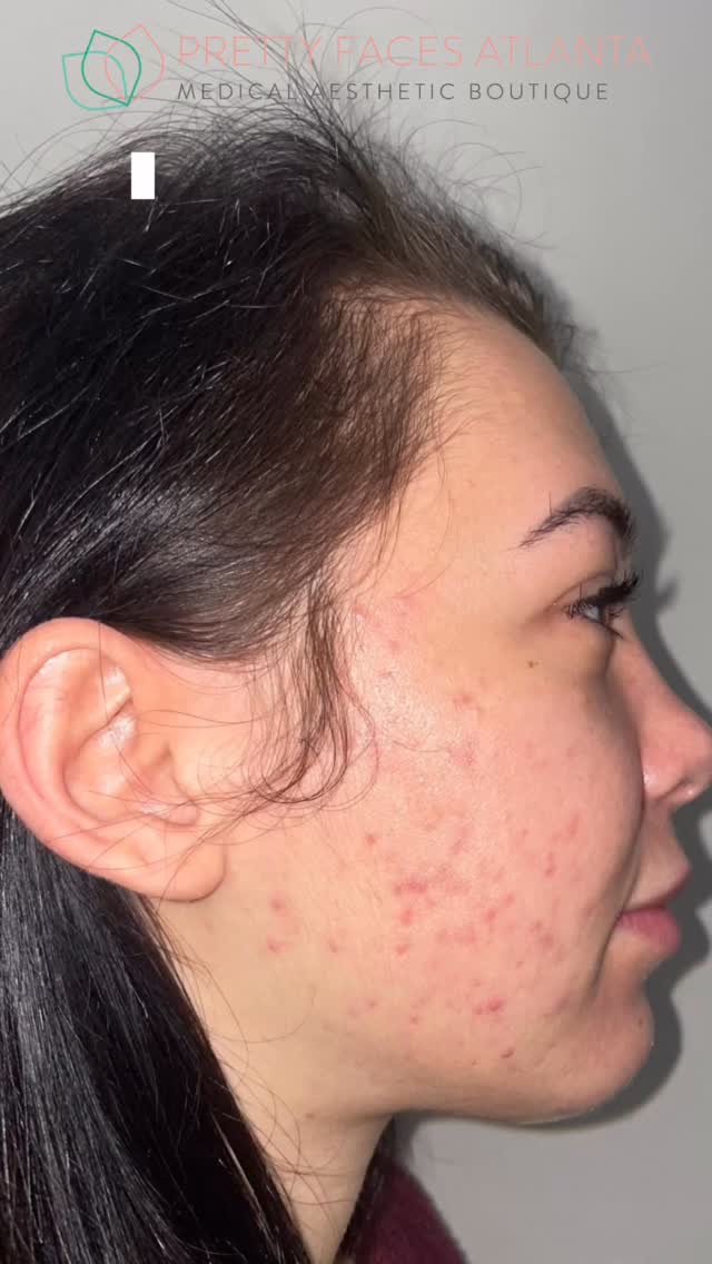 Clear skin isn’t luck… it’s strategy + consistency ✨
If you’ve been dealing with acne, dark spots, redness, or uneven texture, laser treatments are what actually target the root of the problem not just the surface.
At PFA, every treatment starts with a consultation so we can build a plan specifically for YOUR skin. No guessing, no wasting money, just results.
Our laser packages make it easy to stay consistent and see real transformation:
✨ 1 session for $500
✨ 2 sessions for $550
✨ 3 sessions for $800
Consistency is what changes your skin. One session helps… but a plan gets you RESULTS.
Book your consultation today and let’s get your skin right 📲
PrettyFacesAtlanta.com
#PrettyFacesAtlanta #AtlantaMedSpa #LaserTreatment #AcneTreatment #Hyperpigmentation