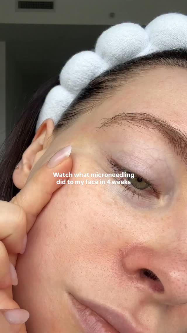 I get it why microneedling is so viral now 🤌🏼 @thevanitylab
Definitely plan to be working from home for the 2-3 days after the treatment (but I also feel like I heal slower so it differs). I was also putting a thick layer of my favourite Trio Luxe moisturizer everyday to help it heal faster, that moisturizer a game changer
See you for another session soon @thevanitylab 🤭
#microneedling #skinhealth