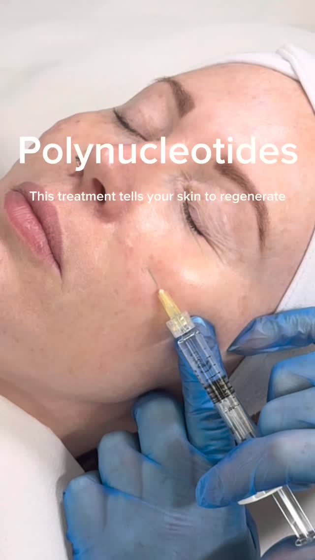 ✨ POLYNUCLEOTIDES – THE SECRET TO SKIN REGENERATION ✨
Looking for healthier, firmer, glowing skin from within? Polynucleotides are one of the most advanced treatments for true skin rejuvenation. 💫
WHAT ARE POLYNUCLEOTIDES?
Polynucleotides are powerful regenerative molecules that work at a cellular level to repair, hydrate, and restore the skin. They stimulate your skin’s natural healing processes — not just treating the surface, but improving skin quality from within.
BENEFITS:
✨ Boost collagen & elastin production
✨ Deeply hydrate and improve skin texture
✨ Improve skin elasticity & firmness
✨ Reduce fine lines and wrinkles
✨ Brighten dull, tired skin
✨ Support skin repair and regeneration
✨ Help with acne scarring and uneven skin
PERFECT FOR:
• Under eyes (dark circles, fine lines, crepey skin)
• Face (overall rejuvenation & glow)
• Neck (loose or ageing skin)
This treatment is all about long-term skin health, giving you a natural, refreshed look rather than anything overdone. 🤍
Ready to level up your skin? Message us to book your consultation.
#polynucleotides #skinrejuvenation #polynucleotideswarrington #polynucleotidescheshire #aestheticswarrington