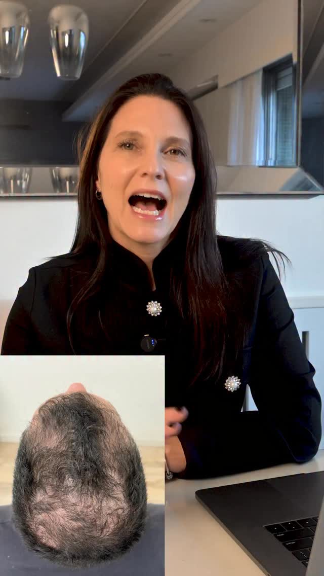 ¿Se te cae el pelo? 🚨
No lo ignores… porque sí tiene solución.
💥 Frená la caída + recuperá densidad con un enfoque real:
💉 PRP
💉 Mesoterapia con dutasteride
💊 Minoxidil + dutasteride oral
🔥 La clave: combinar tratamientos para resultados visibles y duraderos.
⚠️ Cuanto antes empezás, mejor responde el folículo.
👇 Leo tus comentarios
📲 1166662866
✨ Tenemos solución a tu problema
#CaidaDePelo #Alopecia #PRPcapilar #Dutasteride #Minoxidil HairGrowth Dermatologia SaludCapilar