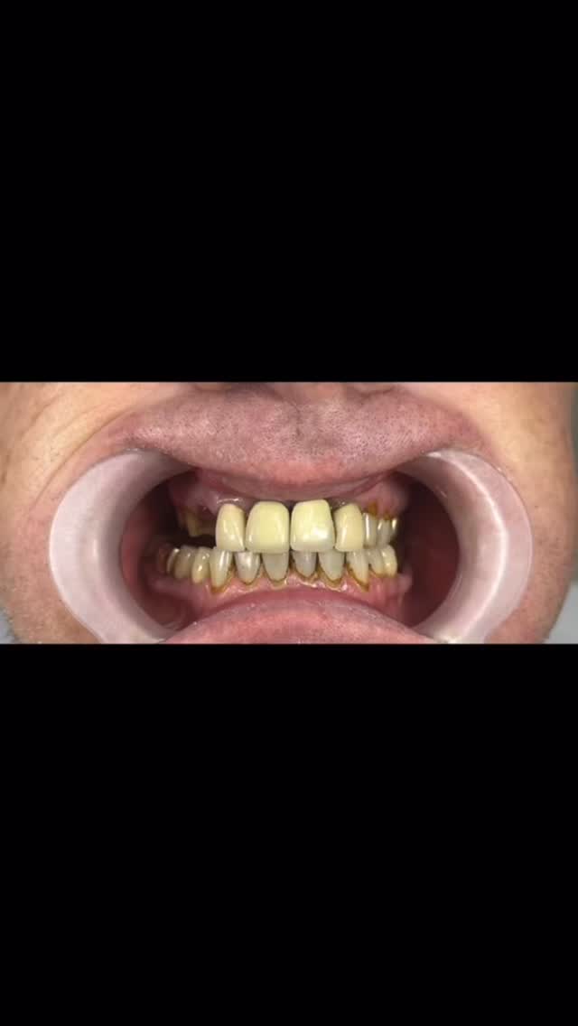 #deutschland #dental #viralpost #fyp #smile
Wir wünschen unseren Patienten viel Freude und Zufriedenheit mit ihren neuen Zähnen und ein strahlendes, selbstbewusstes Lächeln.