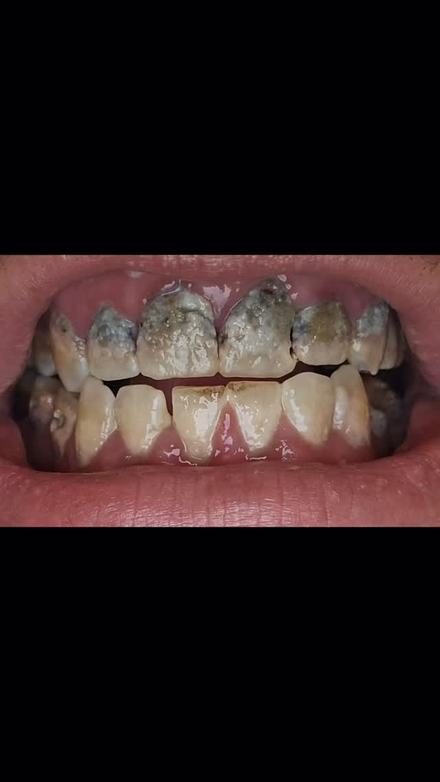 #dental #deutschland #istanbul #fyp #zahnbehandlung
Im Rahmen der ersten Behandlung wurden insgesamt 6 Implantate erfolgreich eingesetzt. Der Eingriff erfolgte unter Sedierung, um dem Patienten maximalen Komfort zu gewährleisten. Der Patient verbrachte anschließend 4 Nächte in der vorgesehenen Unterkunft.
Nach einem Zeitraum von mehreren Monaten erfolgte der zweite Besuch. In diesem Rahmen wurden 10 Wurzelkanalbehandlungen durchgeführt sowie 28 Kronen präzise eingesetzt. Auch dieser Eingriff fand unter Sedierung statt. Der Patient blieb für die Dauer von 7 Nächten in der Unterkunft.
Sämtliche Behandlungen wurden unter strengsten sterilen Bedingungen und mit größter Sorgfalt durch unsere erfahrenen Fachärzte durchgeführt.
Wir wünschen Ihnen weiterhin beste Gesundheit und alles Gute.