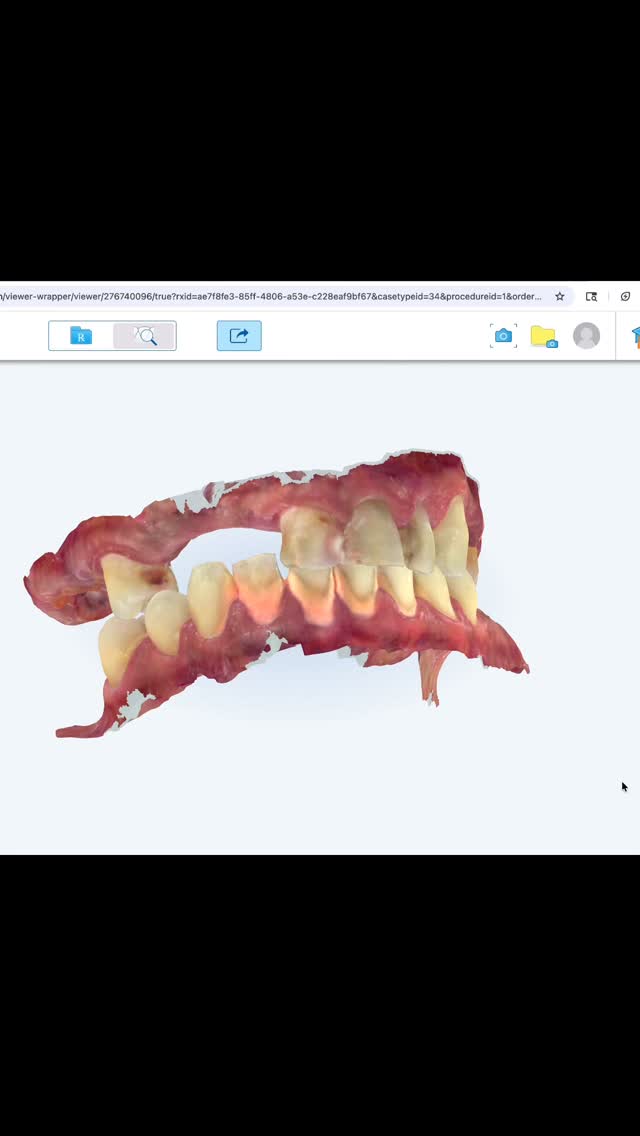 His story: He talked about this for years…
Told his coworkers and friends he’d do it one day. ⏰
Today — he finally did. 💪🏼
Confidence restored in just one day. 🔥
#orlandodentist #dentalbridge #dentalimplants