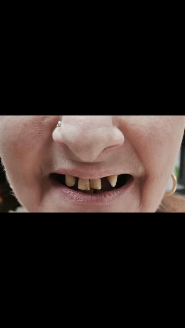 #dental #istanbul #allonsix #deutschland #Zahnbehandlung
Bei unserer Patientin wurden insgesamt
12 Implantate eingesetzt, einschließlich eines Knochenaufbaus sowie eines
Sinuslifts.
Nach einem Heilungsprozess von 6 Monaten kehrte die Patientin zu ihrem zweiten Termin zurück, bei dem die endgültige Versorgung und Eingliederung der Kronen erfolgreich durchgeführt wurde.
Wir freuen uns über das erfolgreiche Endergebnis und wünschen unserer Patientin weiterhin alles Gute sowie viel Freude mit ihrem neuen Lächeln.