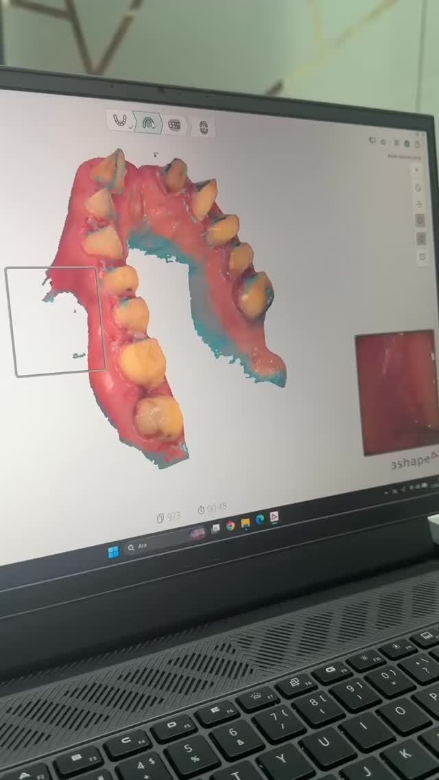 #dental #deutschland #istanbul #digital #viralvideos
Mit unserem hochmodernen und innovativen 3Shape-Digitalgerät werden präzise digitale Abformungen der Zähne erstellt. Diese Daten können in Echtzeit direkt an unser Labor übermittelt werden.
Auf Wunsch unserer Patienten wird bereits in dieser Phase individuell festgelegt, wie die Zähne gestaltet sein sollen – insbesondere in Bezug auf Form und Design der Kronen. Unsere erfahrenen Zahntechniker beginnen daraufhin unmittelbar mit der Anfertigung und geben den Kronen im Anschluss den letzten Feinschliff, um sowohl maximale Stabilität als auch höchste ästhetische Ansprüche zu gewährleisten.
Die endgültige Farbwahl erfolgt selbstverständlich durch unsere Patienten selbst – mithilfe einer umfangreichen und hochwertigen Farbskala, um ein natürliches und harmonisches Ergebnis zu erzielen.