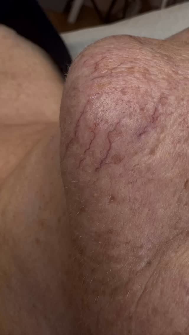 Not every treatment starts with “let’s remove it.”
It starts with “let’s do this safely.”
This is exactly why consultation is essential.
Same area, same concern… but never the same approach.
This client has slower healing and is immunosuppressed, which means we need to take extra care with how the skin responds. Instead of treating everything in one go, I’ve carried out a small test patch using two different currents.
Why?
So we can understand exactly how her skin heals and responds before proceeding further.
We’ll review this in 4–6 weeks, and from there, build a treatment plan that is tailored, safe, and clinically appropriate for her.
Because this isn’t just about removing veins.
It’s about doing it properly.
Patient safety will always come first. Always.
#PatientSafety #SkinClinic #AdvancedCosmeticPractitioner #ThreadVeins #SkinHealth ConsultationFirst TestPatch ClinicalExcellence SkinTreatment AestheticSafety BespokeTreatment SkinCareProfessionals