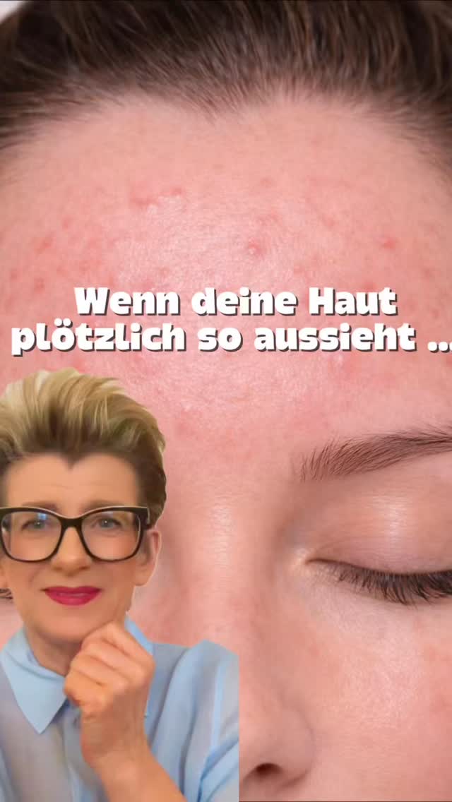 Sieht aus wie unrein.
Ist es oft nicht.
Viele Hautbilder wie dieses entstehen nicht durch „Unreinheiten”, sondern durch eine Haut, die ihre Balance verloren hat.
👉🏼Die Feuchtigkeit wird nicht mehr gehalten
👉🏼Die Haut reagiert schneller auf Reize
👉🏼Und genau dadurch entstehen Rötungen und Irritationen
Das Problem:
Es wird ständig etwas Neues ausprobiert - und die Haut kommt nie zur Ruhe.
Was sich verändert, wenn du richtig ansetzt:
✔️Die Haut wird ruhiger und gleichmäßiger
✔️Reaktionen nehmen sichtbar ab
✔️Die Haut kommt wieder in ihre eigene Regulation
Der entscheidende Punkt:
Es geht nicht darum, mehr zu machen - sondern gezielt das Richtige.
Und genau da liegt der Unterschied.
CARE4YOU
#hautpflege #beautytips #skincareroutine #gesundehaut #care4you