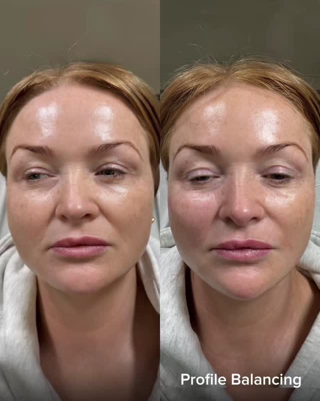 ✨ I’M LOOKING FOR 5 LADIES ✨
Who would love results like these… 🤍
This client had a 4ml refresh and profile balancing — designed to restore structure, enhance proportions, and create a beautifully balanced, natural result. 💫
✨ Improved profile
✨ Restored volume
✨ Enhanced harmony
Subtle changes, big impact — all tailored to you.
I’m opening up 5 spaces for clients ready to start their own transformation journey.
Message now to secure your slot.
#profilebalancing #dermalfillers #aestheticswarrington #warringtonaesthetics #aestheticscheshire