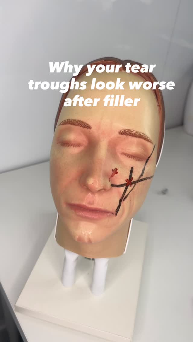 Mid face support isn’t optional when treating the tear trough… it’s the foundation 👇
The tear trough doesn’t age in isolation. Loss of volume in the mid face (malar fat pad + SOOF) is what creates that hollow, tired look in the first place.
If you go straight into the tear trough without rebuilding that support:
• You’re filling a symptom, not the cause
• The hollow can still appear because the cheek isn’t lifting it
• Product can sit heavy, increasing risk of puffiness or migration
• Results look flat, overfilled or unnatural
✨ When you restore the mid face first:
• You lift and support the tear trough naturally
• Less product is needed in the trough itself
• Results are smoother, brighter and longer lasting
• You create structure, not just volume
This is why advanced injectors treat the face as a whole, not isolated lines.
Mid face = support
Tear trough = refinement
Master the structure, and the result speaks for itself 🤍
#aesthetics #antiaging #nonsurgical #liverpool #london