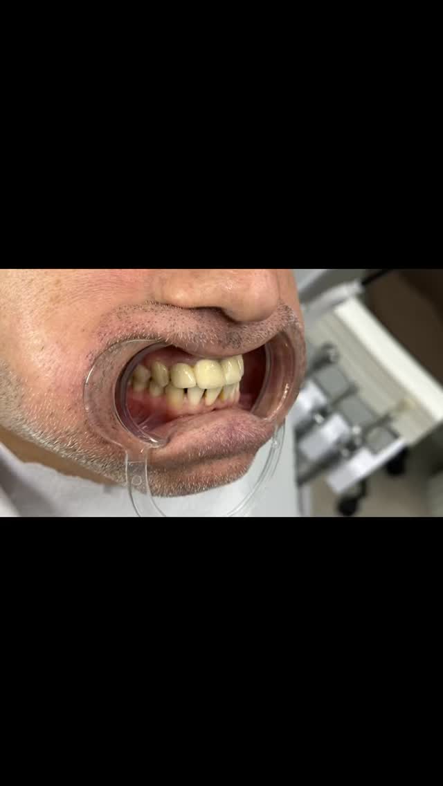 #deutschland #dental #fyp #viralvideos #smile
Der Patient kam mit zahlreichen Beschwerden im Bereich seiner Zähne zu uns in die Klinik. Nach einer umfassenden Behandlung konnte ein ästhetisch und funktional überzeugendes Endergebnis erzielt werden.
Das Resultat kann sich sehen lassen – der Patient ist mit dem Ergebnis sehr zufrieden und verlässt unsere Klinik glücklich.