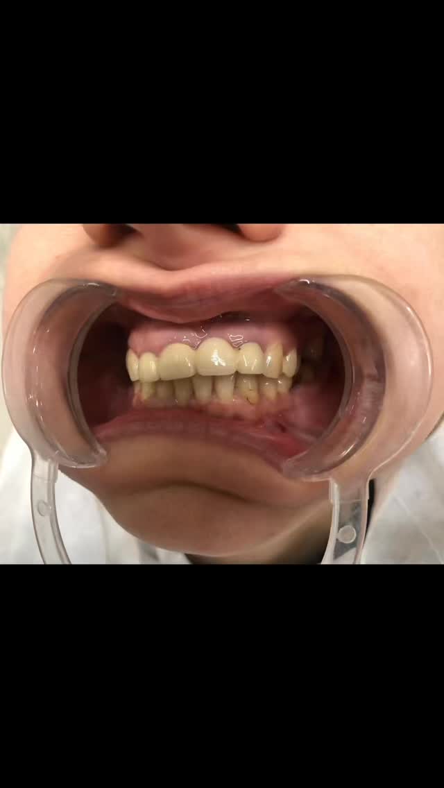 #deutschland #dental #fyp #zahnbehandlung #viralvideos
Die Patientin stellte sich bei uns mit großer Unzufriedenheit vor, nachdem sie bereits im Oberkiefer in Deutschland mit Kronen versorgt worden war, deren Ergebnis ästhetisch und funktionell nicht überzeugte.
Nach einer sorgfältigen Analyse und individuellen Behandlungsplanung haben wir die bestehende Versorgung korrigiert und durch hochwertige, präzise gefertigte Kronen ersetzt.
Das Ergebnis ist ein harmonisches, natürlich wirkendes Lächeln mit optimaler Ästhetik und Funktion – zur vollsten Zufriedenheit der Patientin.