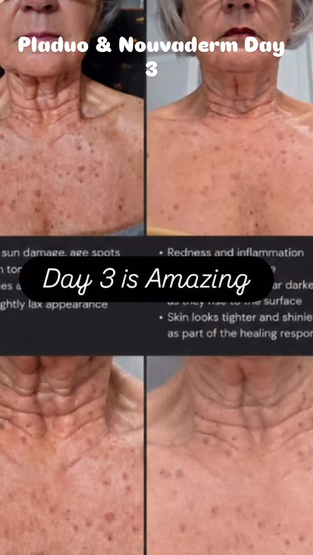✨ REAL RESULTS • REAL SKIN TRANSFORMATION ✨
Day 3 and we are already seeing BEAUTIFUL progress 😍
This is the power of Pladuo + NouvaDerm working together to:
✨ Improve sun damage
✨ Fade age spots
✨ Calm redness & inflammation
✨ Smooth texture
✨ Tighten and rejuvenate the skin
What you’re seeing here is just the beginning—the skin is actively healing, renewing, and bringing fresh, healthier cells to the surface 💫
By combining advanced plasma technology with regenerative skincare, we’re not just treating the surface… we’re resetting the skin from within.
📍 Dunes Med Spa
📲 Call/Text 843-418-4422 to book your consultation
#DunesMedSpa #SkinTransformation #Pladuo #NouvaDerm #BeforeAndAfter SkinRejuvenation SunDamageRepair AgeSpotRemoval GlowingSkin AntiAging MyrtleBeachMedSpa