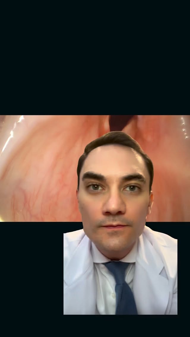 Ela saiu de uma cirurgia com a voz que não era mais a dela.
Voz fraca, soprosa. Engasgos na hora de comer. Aquela sensação de que algo estava errado — porque estava.
A causa: paralisia de prega vocal, uma complicação conhecida que pode ocorrer após de cirurgias no pescoço, crânio ou tórax, que afeta o nervo que controla a laringe.
No vídeo de hoje você acompanha o tratamento: injeção de ácido hialurônico na prega vocal, neste caso realizada com anestesia local, aqui no consultório, com ela acordada e confortável.
O resultado? Voz mais forte, menos risco de aspiração — e ela falando comigo logo depois do procedimento.
Esse é o meu trabalho.
📍 Atendo em Florianópolis
👉 Avaliação pelo link na bio
#rouquidão #paralisiadepregavocal #tireoidectomia #cirurgiadecoluna #cirurgiatorácica