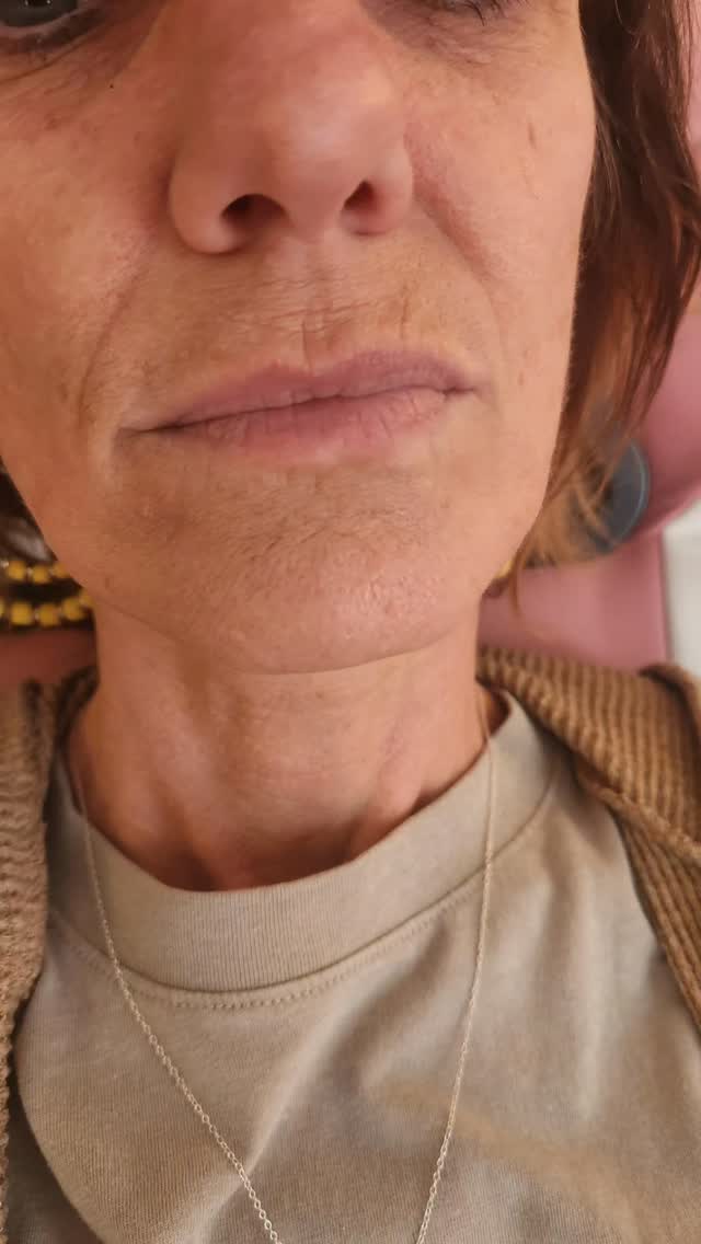 A little Monday night lip action #smallbusiness #aesthetic #lipfiller #lips