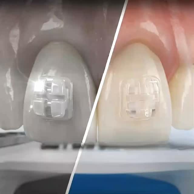 Attacchi in ceramicaGLAM:
l’estetica senza compromessi!
#bracket #brackets #ortodonzia #ortodonziaestetica