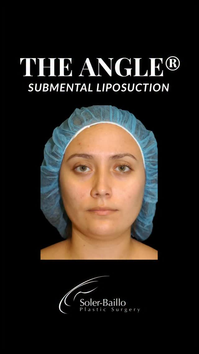 💖 A sharper angle. A stronger profile. A more confident you.
Introducing Dr. Soler-Baillo’s signature procedure, The Angle® — a precision submental liposuction treatment designed to sculpt the jawline, refine the profile, and create elegant definition beneath the chin.
📆 Schedule your consultation today.
📞 305-661-1996
🛍️ Shops at Merrick Park
#theangle #drsolerbaillo #submentalliposuction #chinlipo #resultsmdwellness