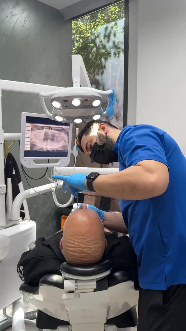 #deutschland #dental #smile #allon6 #fyp
Nach gründlichen Untersuchungen und der Auswertung der Tomographie wurde entschieden, anstelle des All-on-4-Systems ein All-on-6-Implantatsystem durchzuführen. Insgesamt wurden 12 Implantate eingesetzt, zusätzlich erfolgten ein umfangreicher Knochenaufbau sowie 2 offene Sinuslift-Behandlungen mit CC Graft und Membran, um maximale Stabilität und eine langfristige Versorgung zu gewährleisten.
Die gesamte Behandlung verlief reibungslos und erfolgreich. Nun beginnt die wichtige Heilungs- und Einheilphase, die mindestens 6 Monate dauern wird.
Nach Abschluss der Heilungsphase freuen wir uns, Arno wieder in unserer Klinik begrüßen zu dürfen, um die finale Versorgung mit festen Kronen durchzuführen.
Wir wünschen Arno bis dahin weiterhin alles Gute und eine schnelle, problemlose Heilung.