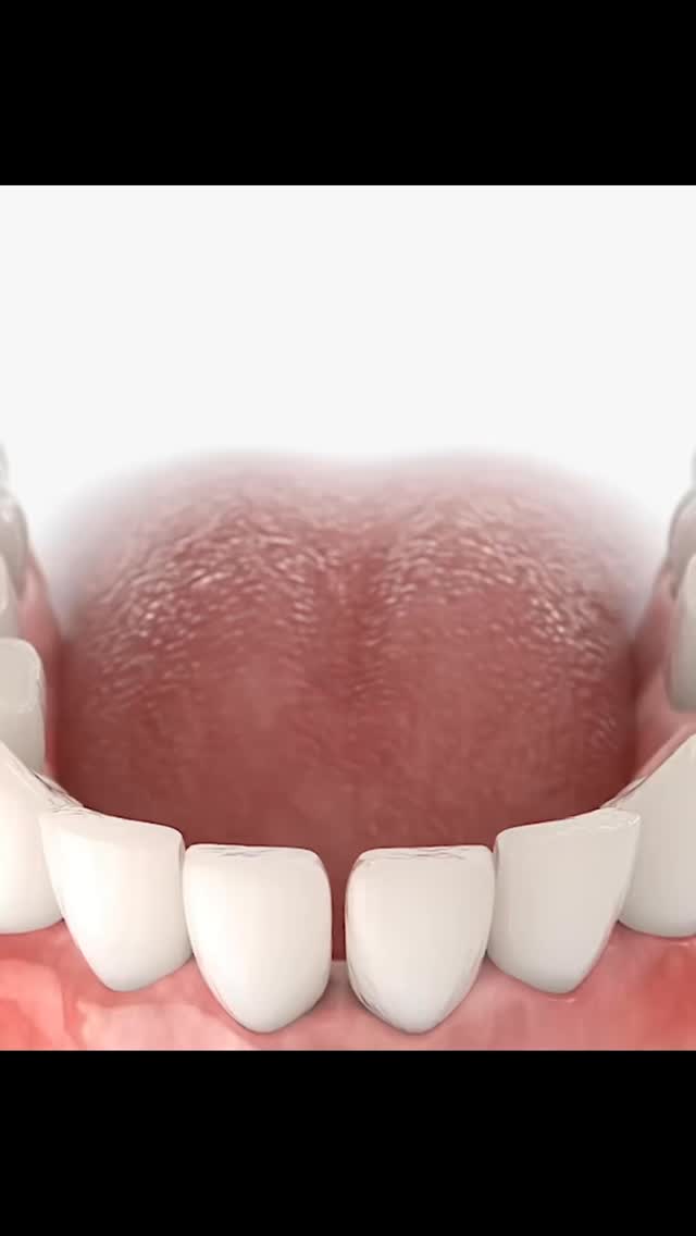 #deutschland #dental #implantat #fyp #smile
In diesem Video sehen Sie den präzisen Ablauf einer modernen Implantatbehandlung.
Zunächst wird der Implantatstift – eine künstliche Zahnwurzel aus hochwertigem Titan – schonend in den Kieferknochen eingesetzt. Dieser Schritt erfolgt unter höchsten medizinischen Standards und sorgt für die stabile Basis des neuen Zahns.
Nach dem Einsetzen beginnt die sogenannte Einheilphase. In den darauffolgenden Wochen bis Monaten verbindet sich das Implantat fest mit dem Knochen – ein Prozess, der als Osseointegration bezeichnet wird. Diese Phase ist entscheidend für die langfristige Stabilität und Haltbarkeit.
Sobald die Einheilung vollständig abgeschlossen ist, folgt der nächste Schritt:
Das individuell angepasste Abutment wird eingesetzt. Dieses Verbindungselement dient als Basis für die spätere Krone.
Abschließend wird die maßgefertigte, ästhetisch perfekte Krone auf dem Abutment befestigt. Das Ergebnis ist ein festsitzender, natürlicher Zahn – sowohl funktional als auch optisch kaum vom echten Zahn zu unterscheiden.
Unser Ziel: Ein gesundes, langlebiges und natürlich schönes Lächeln – mit modernster Technik und maximalem Komfort für unsere Patienten.